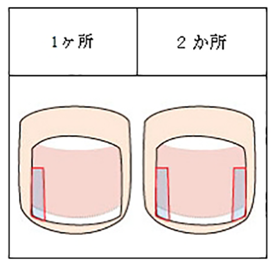 施術方法